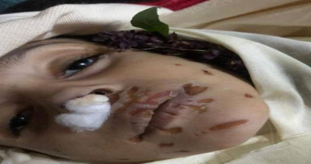 مأساة طفلة يمنية لاقت تعذيبا وحشيا على يد زوجة أبيها حتى الموت